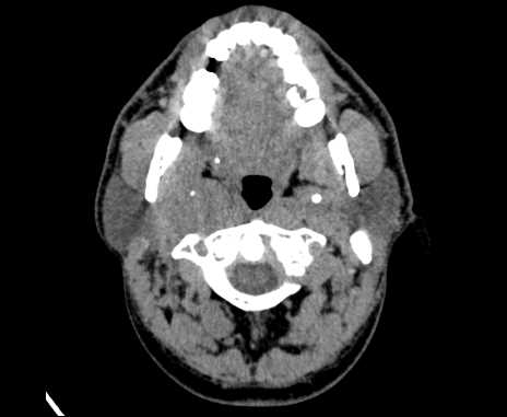 Bilateral carotid body tumors (Radiopaedia 61841-69870 Axial non-contrast 23).jpg