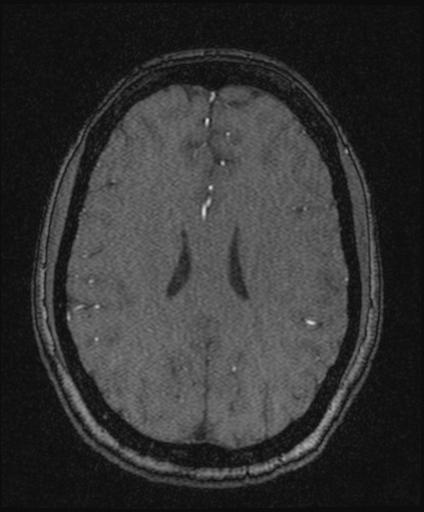 Bilateral carotid body tumors and right glomus jugulare tumor (Radiopaedia 20024-20060 Axial MRA 121).jpg