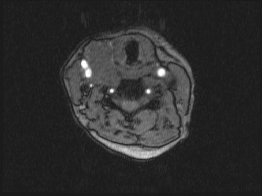 Bilateral carotid body tumors and right glomus jugulare tumor (Radiopaedia 20024-20060 Axial MRA 242).jpg