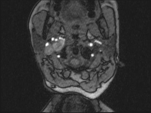 Bilateral carotid body tumors and right glomus jugulare tumor (Radiopaedia 20024-20060 Axial MRA 283).jpg