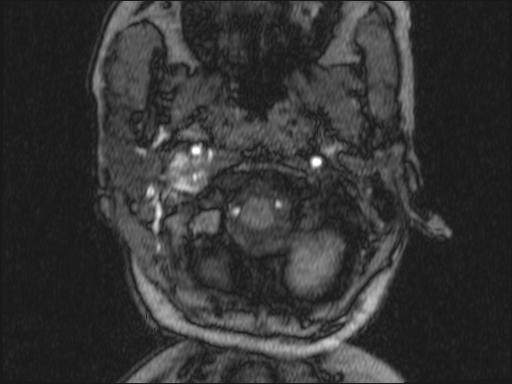 Bilateral carotid body tumors and right glomus jugulare tumor (Radiopaedia 20024-20060 Axial MRA 299).jpg