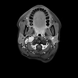 File:Bilateral carotid body tumors and right jugular paraganglioma (Radiopaedia 20024-20060 Axial 103).jpg