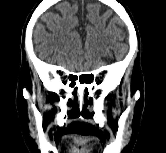 Bilateral ectopia lentis (Radiopaedia 89889-107013 Coronal non-contrast 96).jpg
