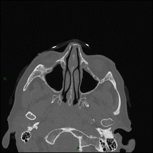 Bilateral frontal mucoceles (Radiopaedia 82352-96454 Axial bone window 181).jpg