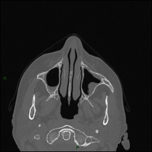 Bilateral frontal mucoceles (Radiopaedia 82352-96454 Axial bone window 212).jpg