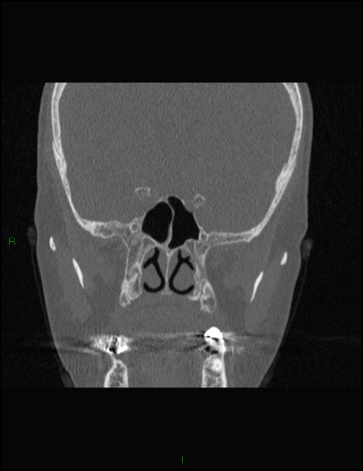 Bilateral frontal mucoceles (Radiopaedia 82352-96454 Coronal 206).jpg