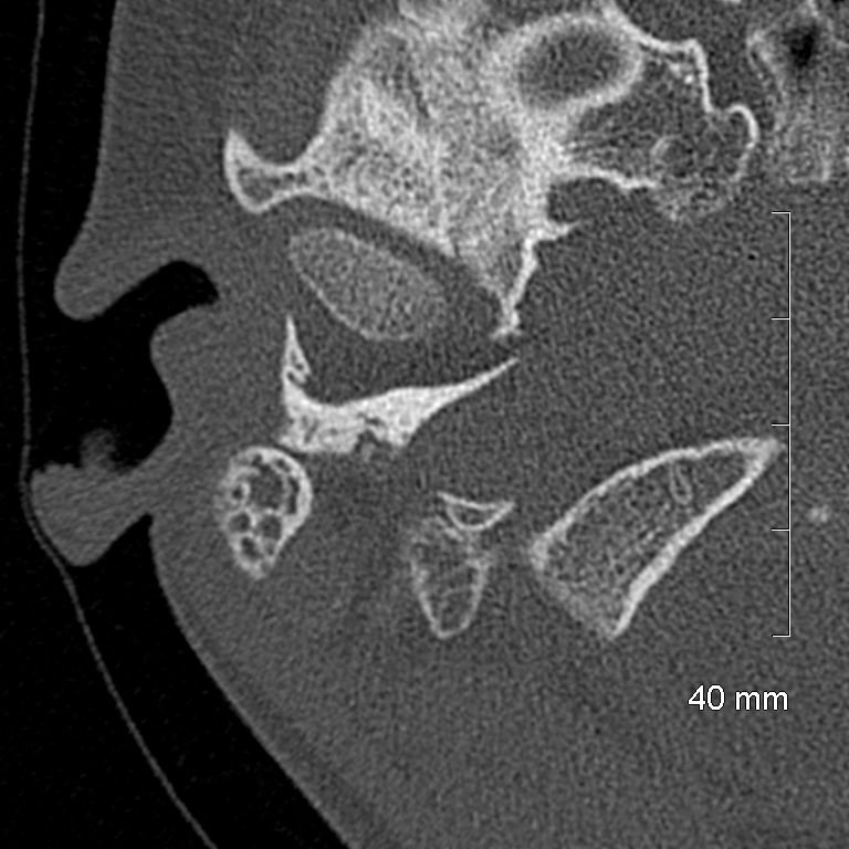 Bilateral grommets (Radiopaedia 47710-52404 Axial bone window 11).jpg