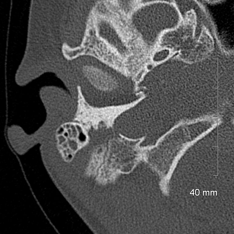 Bilateral grommets (Radiopaedia 47710-52404 Axial bone window 14).jpg