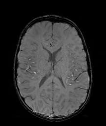 Bilateral mesial temporal polymicrogyria (Radiopaedia 76456-88181 Axial SWI 40).jpg