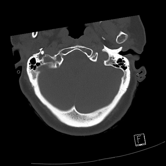 Bilateral occipital condyle fractures (type 3) (Radiopaedia 87672-104086 Axial bone window 6).jpg