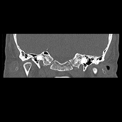 File:Bilateral ossifications of the external auditory canal (Radiopaedia 15233-15076 Coronal bone window 6).jpg