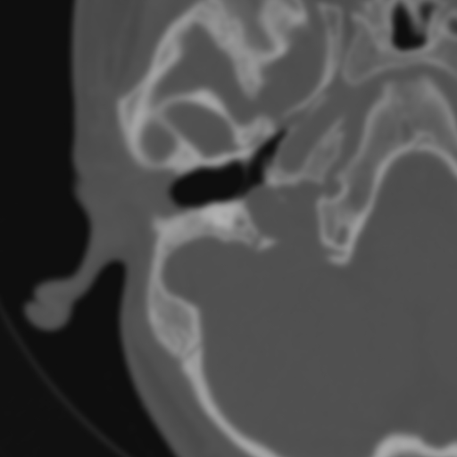 Bilateral otosclerosis (Radiopaedia 57237-64157 B 41).jpg