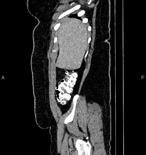 Bilateral ovarian dermoid cysts (Radiopaedia 85785-101603 D 6).jpg