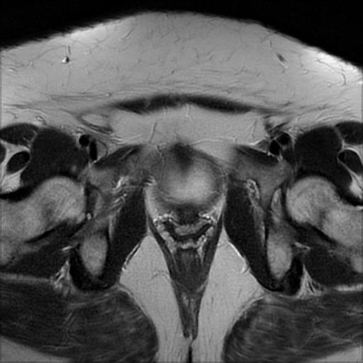 File:Bilateral ovarian dermoid cysts (Radiopaedia 90152-107338 Axial T2 19).jpg