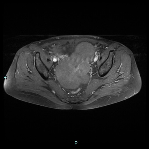 File:Bilateral ovarian fibroma (Radiopaedia 44568-48293 Axial T1 C+ fat sat 14).jpg