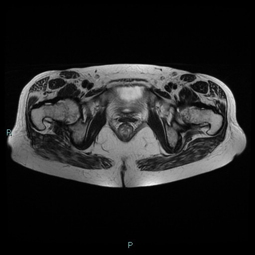 File:Bilateral ovarian fibroma (Radiopaedia 44568-48293 Axial T2 24).jpg