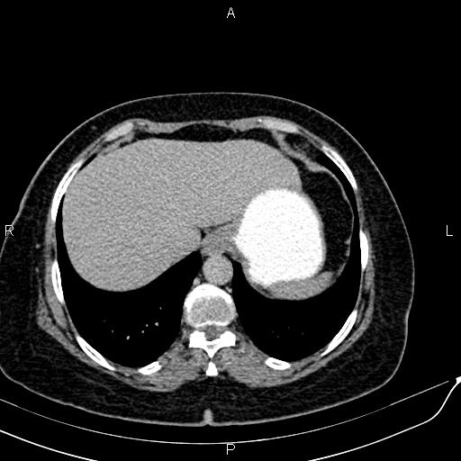 Bilateral ovarian serous cystadenocarcinoma (Radiopaedia 86062-101989 Axial C+ delayed 1).jpg