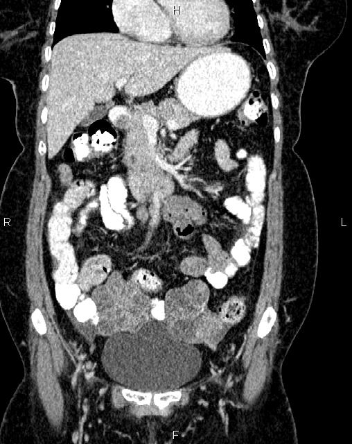 Bilateral ovarian serous cystadenocarcinoma (Radiopaedia 86062-101989 D 13).jpg