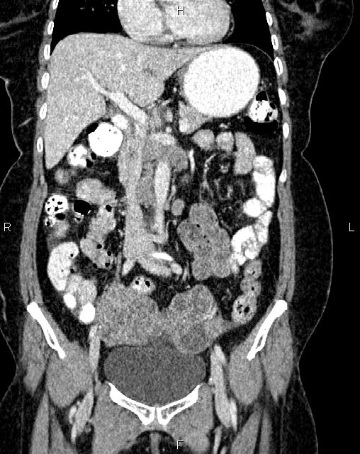 Bilateral ovarian serous cystadenocarcinoma (Radiopaedia 86062-101989 D 17).jpg