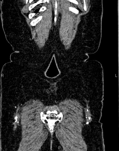 Bilateral ovarian serous cystadenocarcinoma (Radiopaedia 86062-101989 D 56).jpg