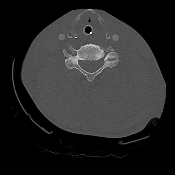 File:Bilateral perched facets with cord injury (Radiopaedia 45587-49713 Axial bone window 67).jpg