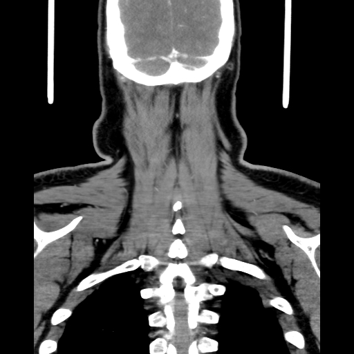 Bilateral peritonsillar abscess (Radiopaedia 85065-100610 Coronal 64).jpg