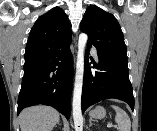 Bilateral pulmonary AVM (Radiopaedia 83134-97505 C 47).jpg