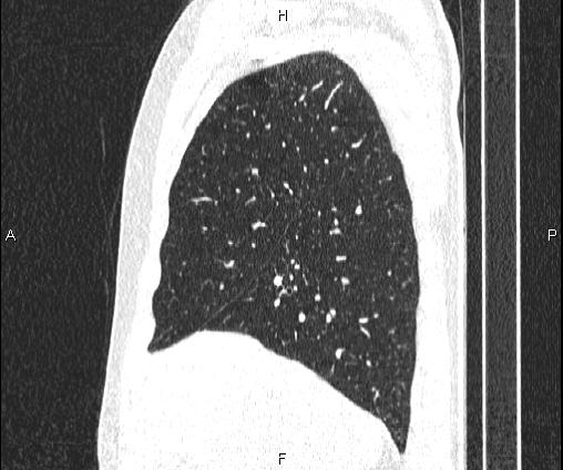 Bilateral pulmonary AVM (Radiopaedia 83134-97505 Sagittal lung window 36).jpg