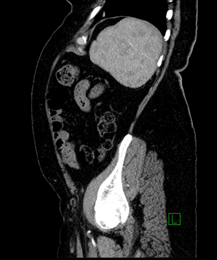 Bilateral sporadic synchronous clear cell renal cell carcinoma (Radiopaedia 85035-100575 E 31).jpg