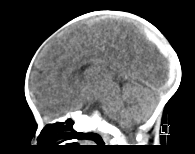 File:Bilateral subdural hemorrhage and parietal skull fracture (Radiopaedia 26058-26192 C 11).png