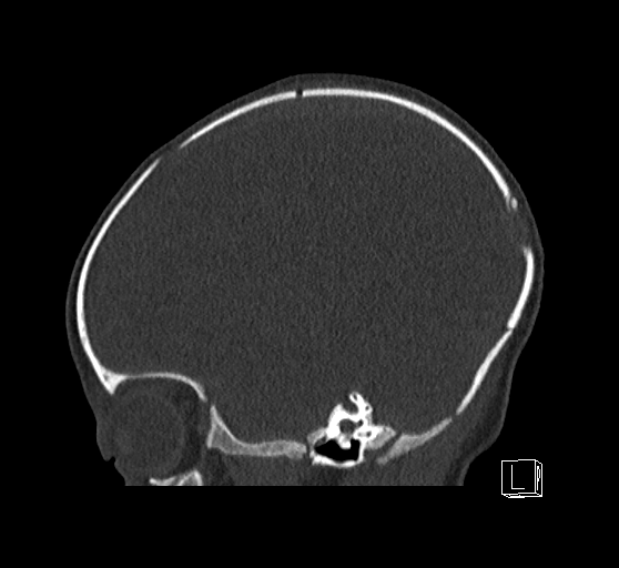 Bilateral subdural hemorrhage and parietal skull fracture (Radiopaedia 26058-26192 Sagittal bone window 70).png