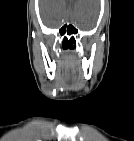 Bilateral submandibular sialolithiasis with sialadenitis (Radiopaedia 70721-80881 Coronal non-contrast 12).jpg