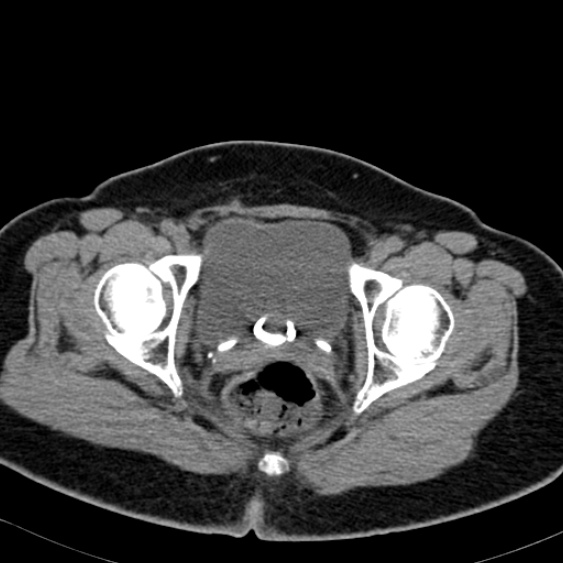 Bilateral ureteric stents (Radiopaedia 48795-53825 Axial non-contrast 64).jpg