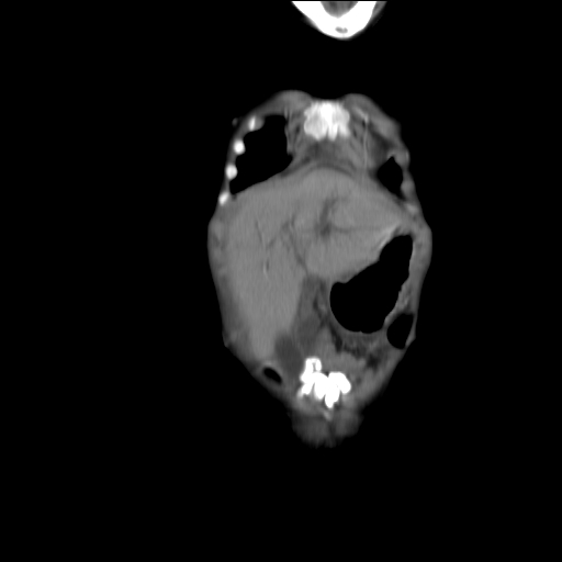 File:Biliary tract embryonal rhabdomyosarcoma (Radiopaedia 51815-57648 B 3).jpg