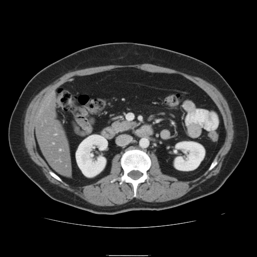 File:Billroth I gastric resection (Radiopaedia 17685-17425 None 18).jpg