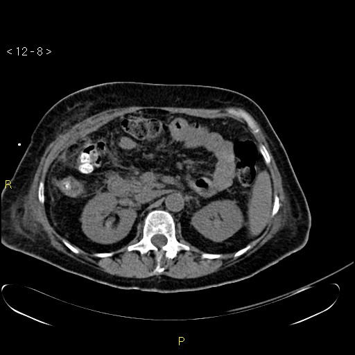 File:Biloma with drainage into the colon (Radiopaedia 20032-20068 B 17).jpg