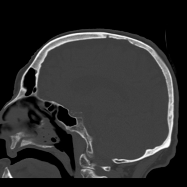 Biparietal osteodystrophy (Radiopaedia 46109-50463 Sagittal bone window 60).jpg
