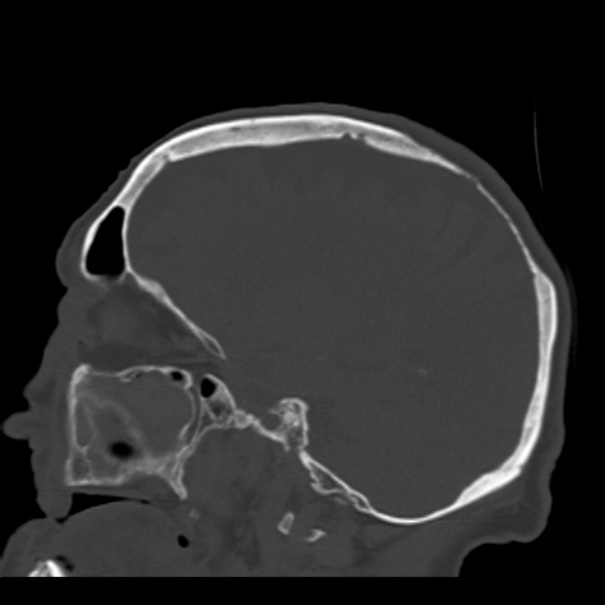 Biparietal osteodystrophy (Radiopaedia 46109-50463 Sagittal bone window 70).jpg
