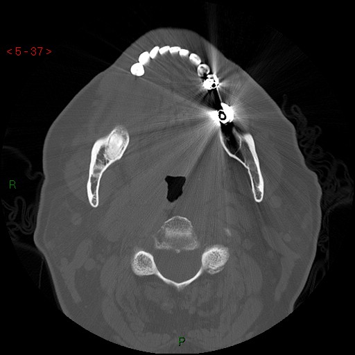 Bisphosphonate-related osteonecrosis of the jaw (Radiopaedia 54147-60329 Axial bone window 31).jpg