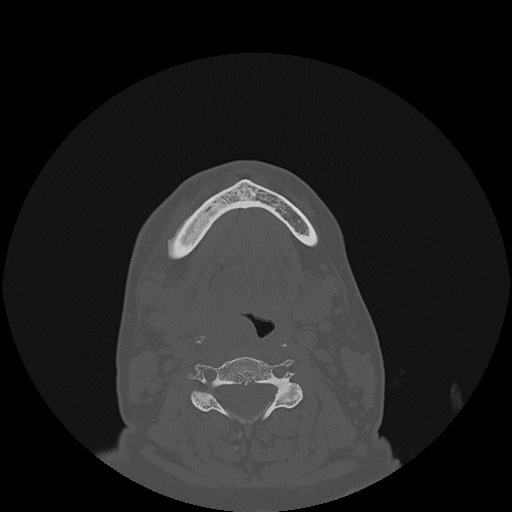 File:Bisphosphonate-related osteonecrosis of the jaw (Radiopaedia 71324-81642 Axial bone window 29).jpg