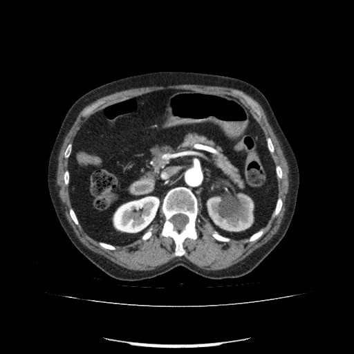 File:Bladder tumor detected on trauma CT (Radiopaedia 51809-57609 A 98).jpg
