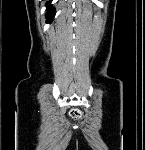 Blind-ending branch of a bifid ureter (Radiopaedia 61159-69048 F 64).jpg