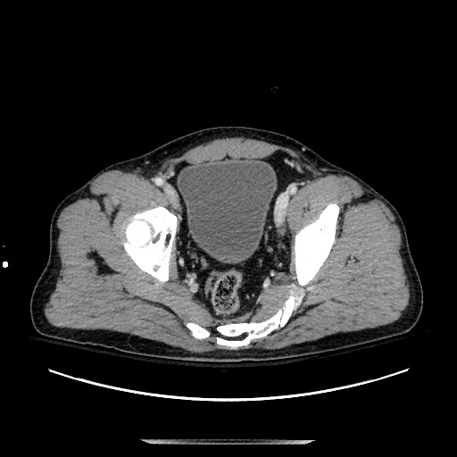 Blunt abdominal trauma with solid organ and musculoskelatal injury with active extravasation (Radiopaedia 68364-77895 A 137).jpg