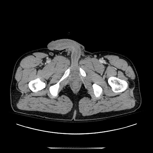 Blunt abdominal trauma with solid organ and musculoskelatal injury with active extravasation (Radiopaedia 68364-77895 A 167).jpg