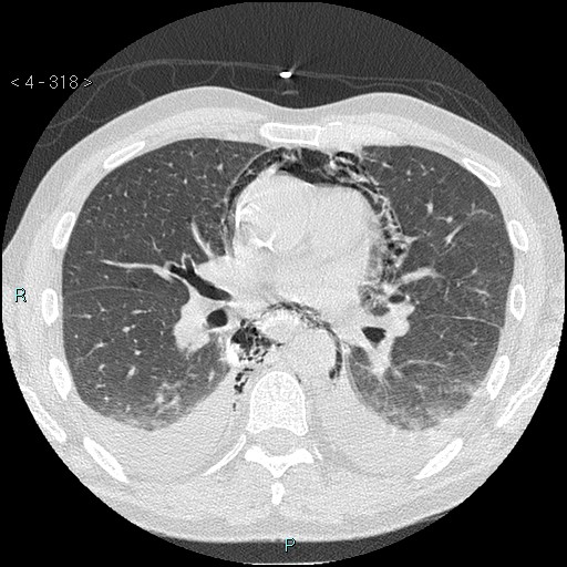 File:Boerhaave syndrome (Radiopaedia 27683-27897 lung window 39).jpg