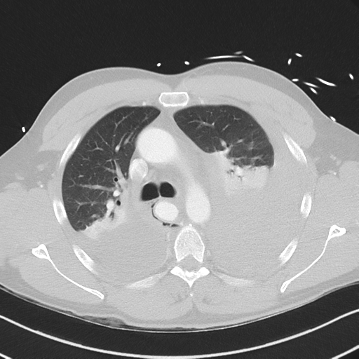 Boerhaave syndrome (Radiopaedia 39382-41661 Axial lung window 20).png