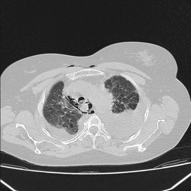 Boerhaave syndrome (Radiopaedia 45644-49799 Axial lung window 43).jpg
