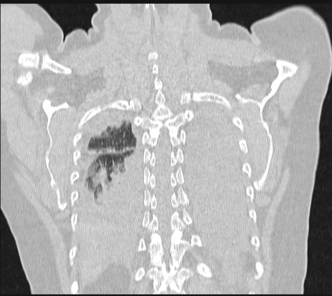 Boerhaave syndrome (Radiopaedia 45644-49799 Coronal lung window 58).jpg