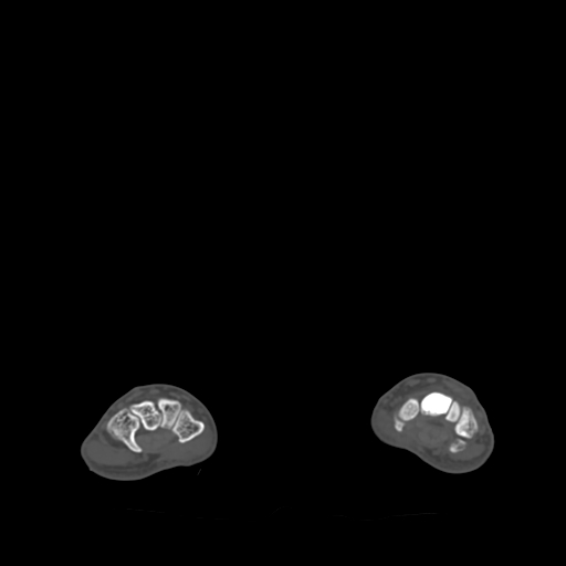 File:Bone islands - carpus (Radiopaedia 63141-71658 Axial bone window 39).jpg