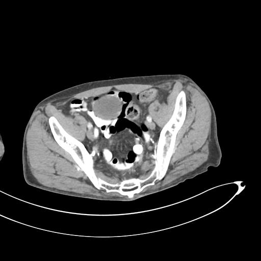 Bone metastasis from squamous cell carcinoma (Radiopaedia 30133-30730 B 62).jpg